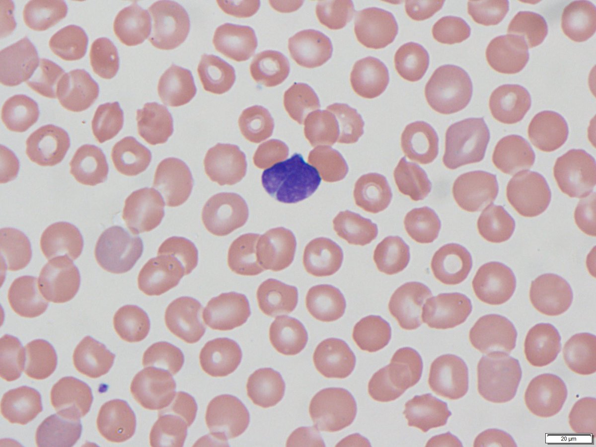 70 year old man with history of lymphoma. What kind of lymphoma does he have? #MedTwitter #PathTwitter #heme