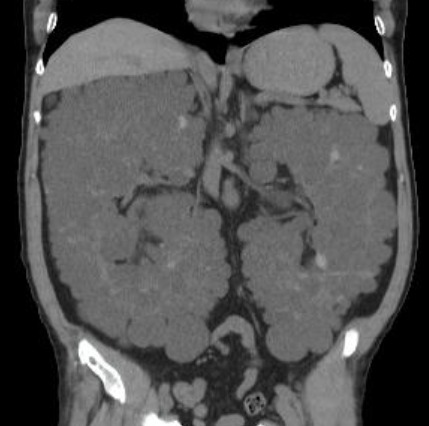 Here the problem is not the diagnosis itself but rather what to include in the report? 🤔 Important findins to evaluate: 🔵 Kidneys' size 🟢Cysts complications 🟣Vascular calcification Among others! Complete case review 🇪🇸 (subs) 👇🏻 🔗youtu.be/VEGlWaIBoTE #radiology