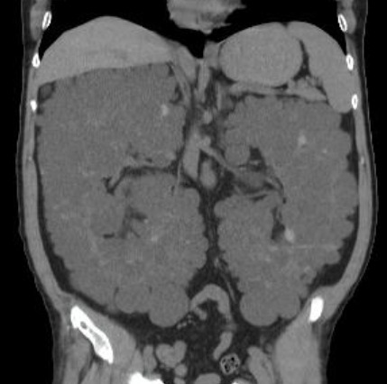Here the problem is not the diagnosis itself but rather what to include in the  report? 🤔
Important findins to evaluate:
🔵 Kidneys' size 
🟢Cysts complications
🟣Vascular calcification
Among others! 
Complete case review 🇪🇸 (subs) 👇🏻
🔗youtu.be/VEGlWaIBoTE
#radiology