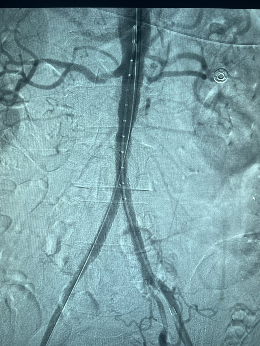 dbgans's tweet photo. Two CERABs in two days. Both poor surgical candidates. Second one got renal artery, SMA, and celiac stents too, all in single session. Claudicant, resistant HTN, and CMI. @SIRRFS @SIR_ECS @UICOMPRadiology https://t.co/8i7AgJUSI2