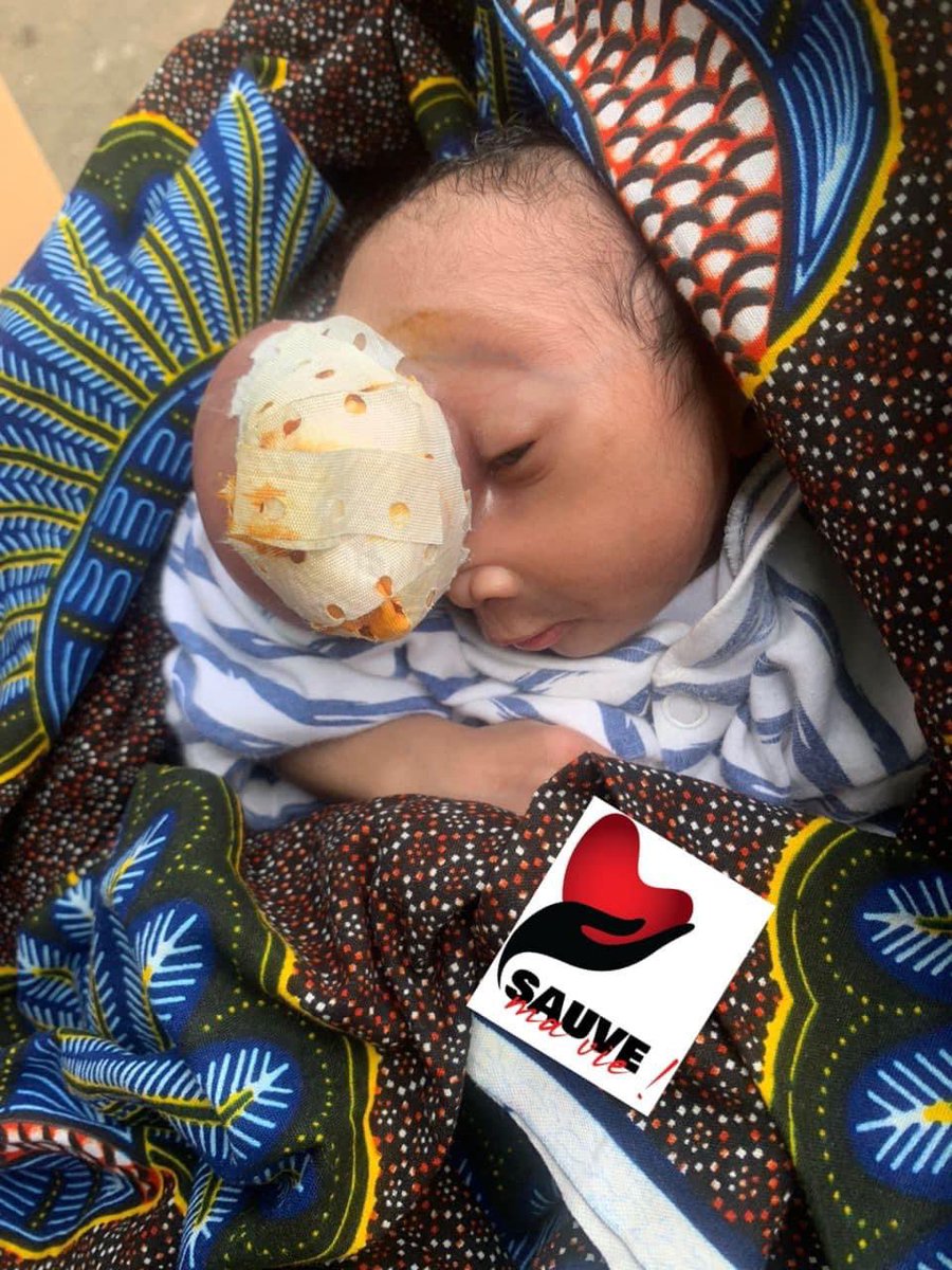 cherifmohamed_'s tweet photo. Nous avons fait tout ce qui était en notre pouvoir pour essayer de sauver notre bébé Miracle. Cependant, suite aux examens et aux bilans, l'anesthésiste a clairement indiqué que les chances de survie de cet enfant étaient très faibles, et il risquait même de ne pas survivre à l'opération. 

Finalement, il devra vivre avec cette tumeur, ce qui nous attriste profondément 😞 Néanmoins, nous gardons espoir en un miracle, car le nom de notre bébé lui-même indique que Dieu n'a pas encore prononcé son dernier mot dans cette histoire.

Pour l'instant, nous pouvons soutenir notre bébé en lui fournissant du lait, des couches, et des savons, tout en priant pour lui et pour sa mère qui est très déboussolée.

Sauve ma vie 🩸
