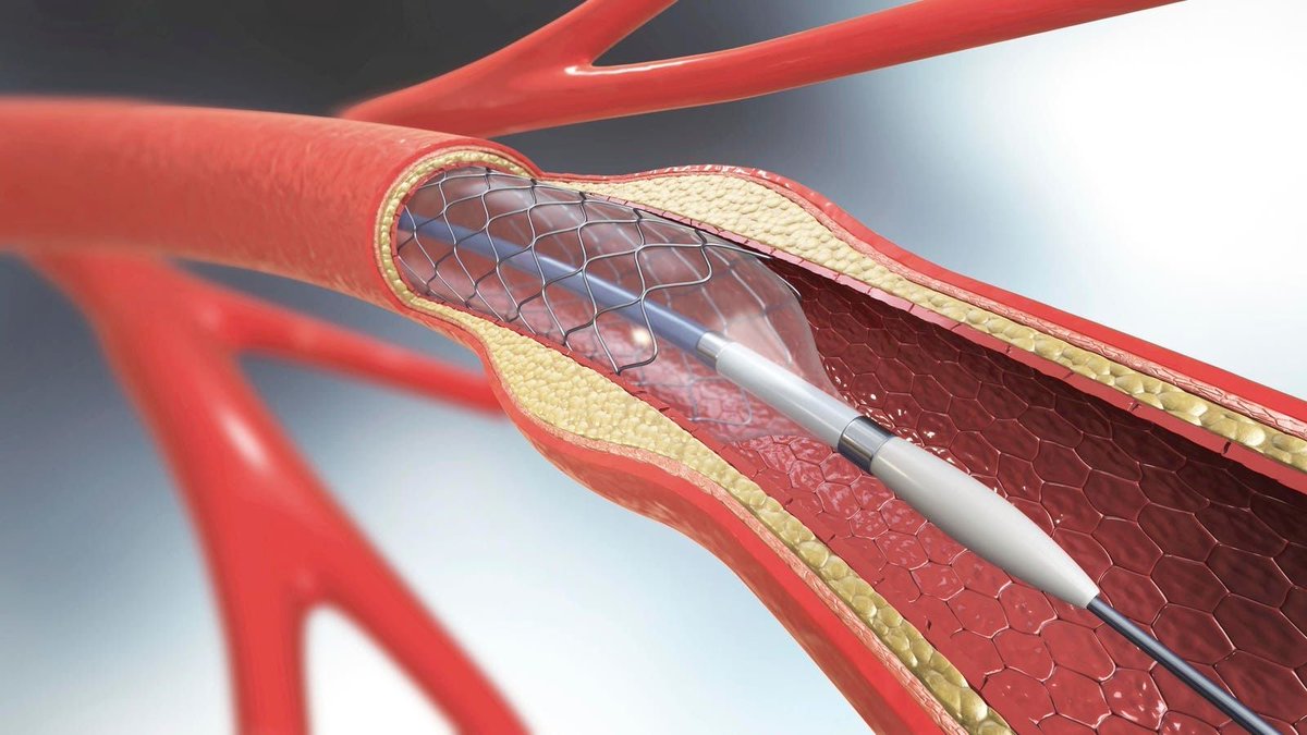 A new report published Tuesday found over one in five coronary stents placed between 2019 and 2021 were unnecessary, costing Medicare $800 million a year and putting patients at risk of complications like stroke, heart attack and death. buff.ly/40kKpPk