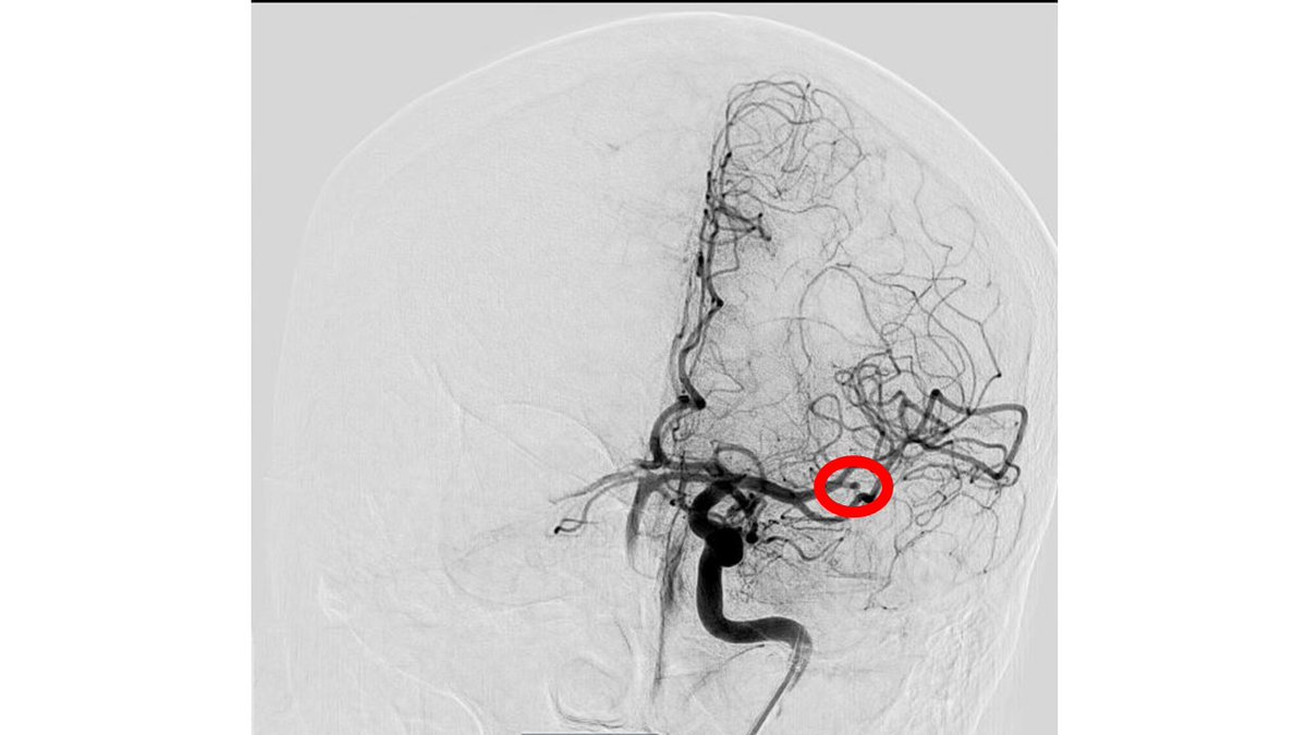 PenNeuro's tweet image. US HCPs: Check out this fantastic first pass result using RED 43 in left M2 from Dr. Amir Khan out of OC, CA! No clinical deficits or MRI infarct observed post thrombectomy. Thank you for sharing! #RED43 Rx only. Risk info: bit.ly/2BYj7Yj. Clinical results may vary.