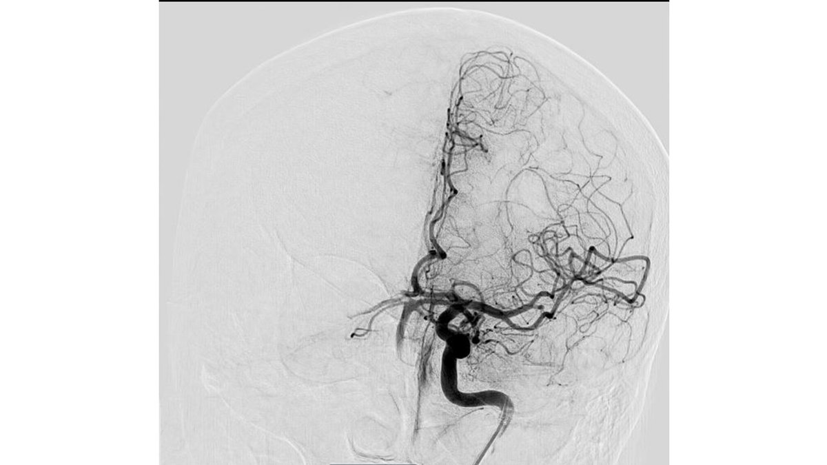PenNeuro's tweet image. US HCPs: Check out this fantastic first pass result using RED 43 in left M2 from Dr. Amir Khan out of OC, CA! No clinical deficits or MRI infarct observed post thrombectomy. Thank you for sharing! #RED43 Rx only. Risk info: bit.ly/2BYj7Yj. Clinical results may vary.