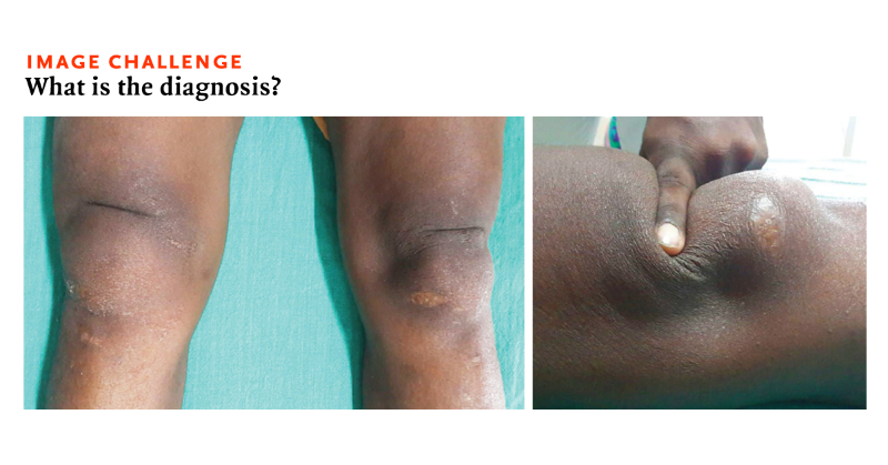 NEJM's tweet photo. A 38-year-old man with end-stage renal disease who was undergoing hemodialysis presented to the hospital with several years of progressive difficulty in walking. Read the full case details and submit your answer or see how others responded: https://t.co/yZulLkerJ0