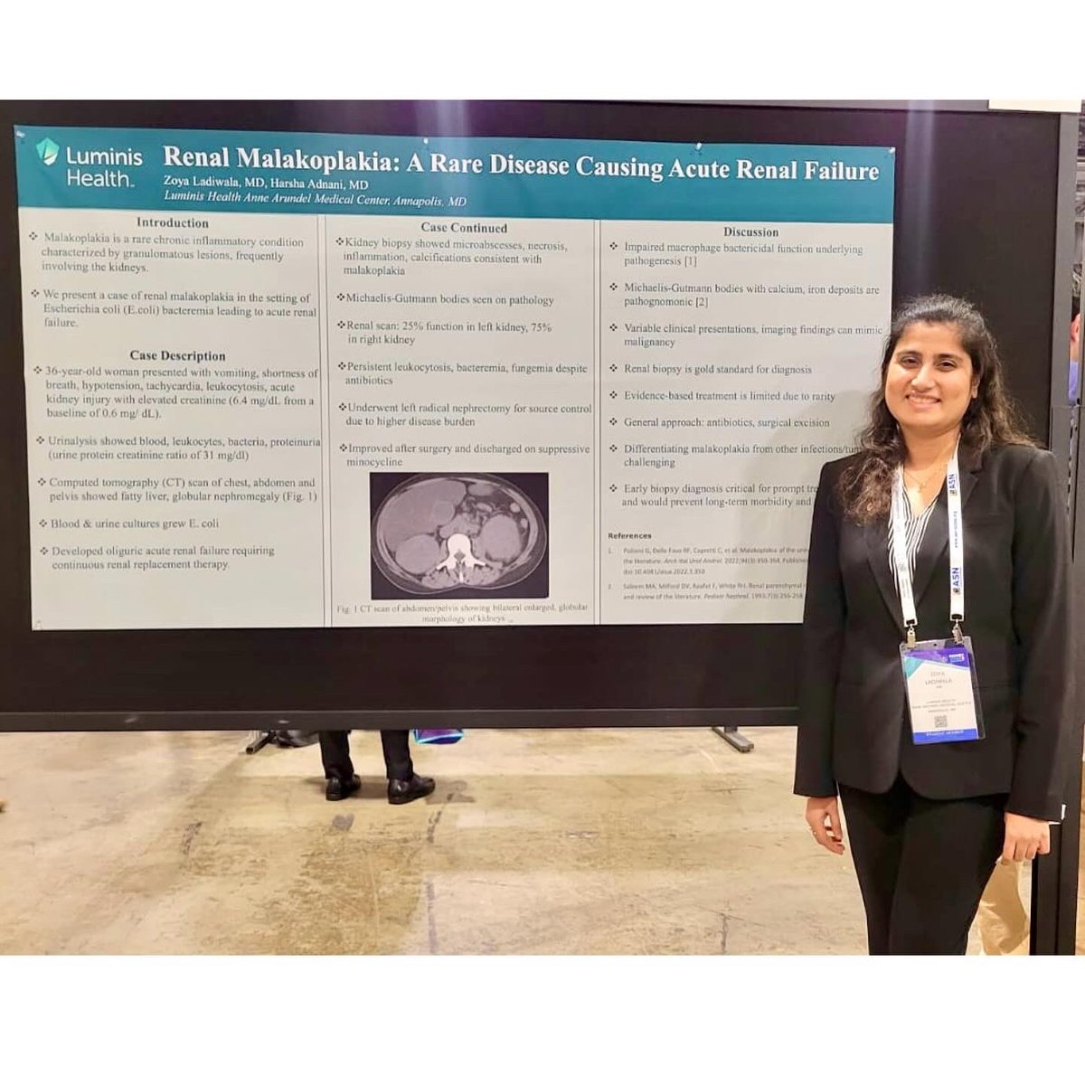 AAMC_IMRes's tweet photo. Our shining star, Dr. Zoya Ladiwala PGY-3, making waves at the #kidneyweek Annual Society of Nephrology in Philadelphia! 🌟😍👏🏻

#ASN2023 #kidneywk #posterpresentation #scholaryactivities #beanlover #anne_arundel_im_residency https://t.co/eBJBqTyX08