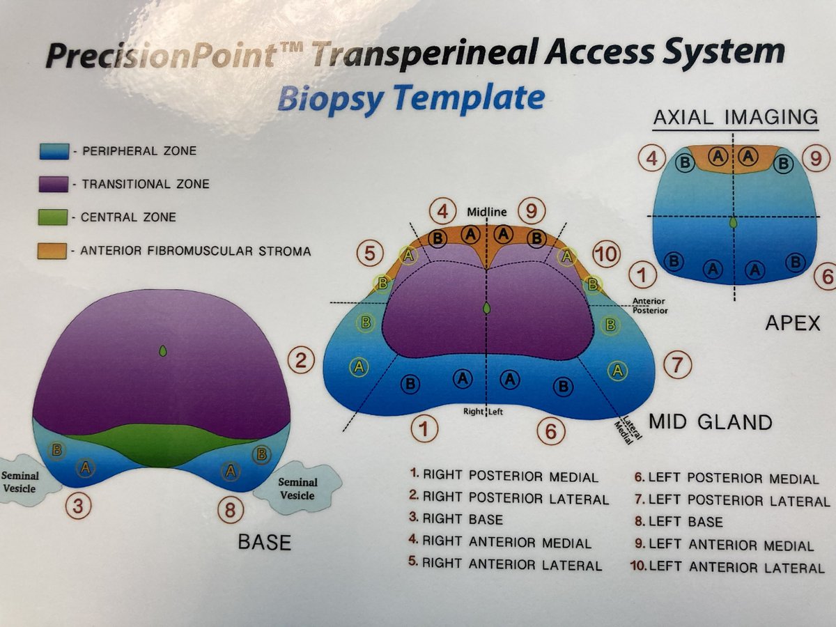 Rajendra Sukhraj (@rcsukhraj) on Twitter photo Excellent hands-on transperineal prostate biopsy training for Caribbean urologists, proctored by <a href="/jonmakUrology/">Jonathan K. Makanjuola</a>
Thank you <a href="/PNLogic/">Perineologic®</a> <a href="/PersaudDr/">Satyendra Persaud MBBS DM (Urol) FRCS FACS FFSTEd</a> <a href="/CaribbeanUrolo1/">Caribbean Urological Association</a> for making this possible. Excellent hands-on transperineal prostate biopsy training for Caribbean urologists, proctored by <a href="/jonmakUrology/">Jonathan K. Makanjuola</a>
Thank you <a href="/PNLogic/">Perineologic®</a> <a href="/PersaudDr/">Satyendra Persaud MBBS DM (Urol) FRCS FACS FFSTEd</a> <a href="/CaribbeanUrolo1/">Caribbean Urological Association</a> for making this possible.