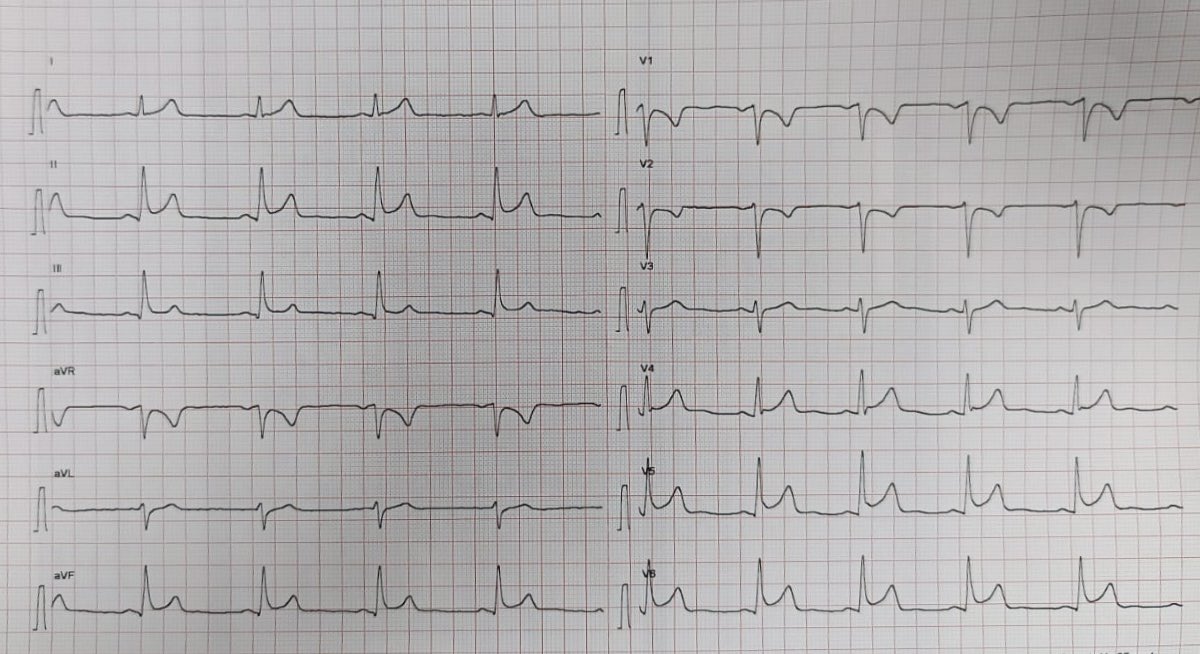 NeuroQuinn's tweet image. #ECGAnalysis
Normal axis 
Sinus bradycardia @ 56 bpm
ST elevation in infero lateral leads with anterior reciprocal changes.
Occlusion of proximal left circumflex artery 
Treatment : Straight to cath lab for PPCI .
#EmergencyMedicine #Cardiology
