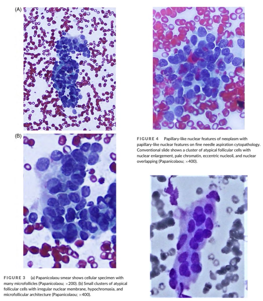 DiagnosticCyto's tweet photo. Read this new article re : “Detailed #FNA #cytopath findings of #NIFTP with nuclear grading correlated to that of biopsy and Bethesda category and systematic review” https://t.co/JQsayXx2Xj cc: @aakasharmand @IACytology @USFNA_SPAIN @britishcytology @PapSociety @PoonamVohra3 https://t.co/Lwwhy0WvwJ