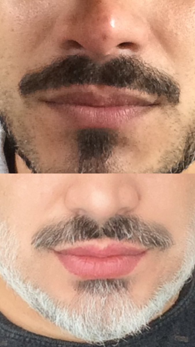 rogerioh_'s tweet image. Estava vendo meu antes e depois do #preenchimentolabial e gente que mudança ! #acidohialuronico eu te amo