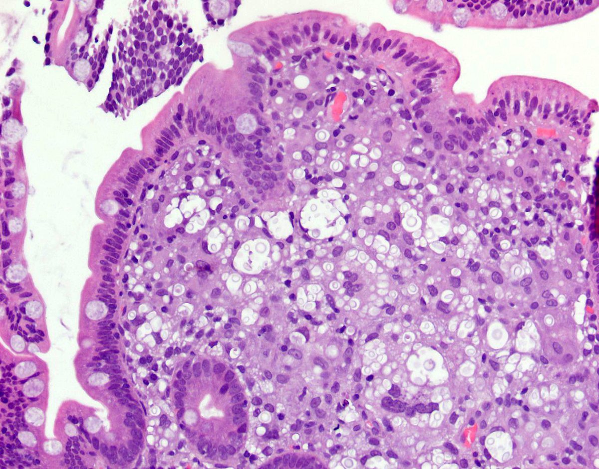 MonicaGarciaBu2's tweet photo. Duodenal bx from an immunocompromised pt with variably sized yeasts (3-8 microns) with a thick capsule of glucuronoxylomannan. PAS+, GMS+, Mucicarmine+, Fontana Masson+:   Cryptococcus neoformans @UMiamiPathology @USGIPS @AmCollegeGastro #PathTwitter #pathresidents #GIpath https://t.co/qTGhZ05RDg