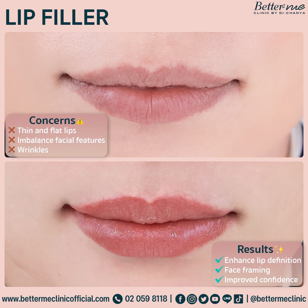 bettermeclinic's tweet image. A whole new level of confidence with just 1 CC!  💋💫 A good example on our beautiful patient @merisa_fourie When just 1 CC of #filler transforms your entire look. #EnhancingNaturalBeauty  #TotalTransformation #ConfidenceBoost
#lipfiller
#bangkokexpat #bangkokexpatgirls