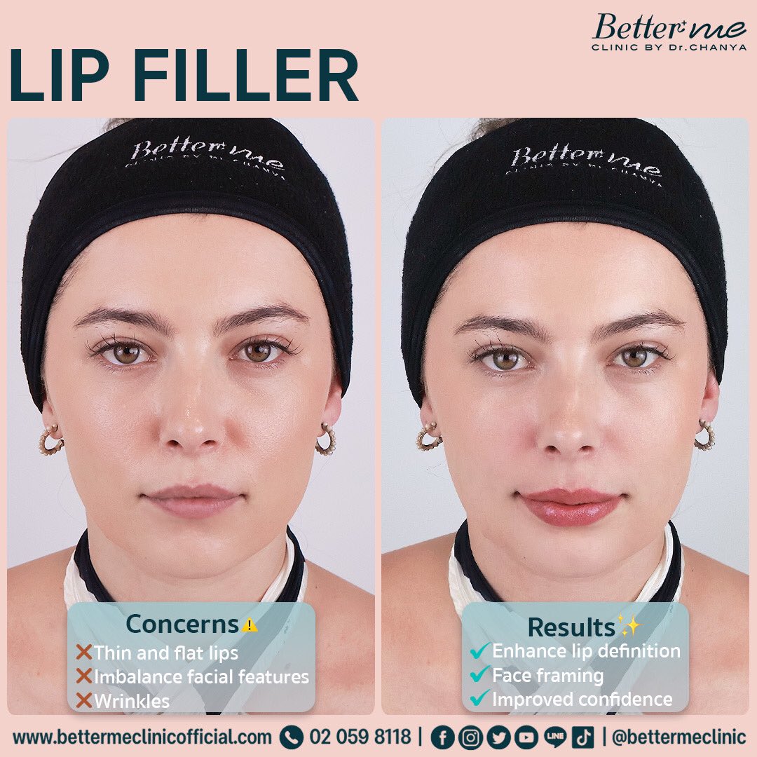 bettermeclinic's tweet image. A whole new level of confidence with just 1 CC!  💋💫 A good example on our beautiful patient @merisa_fourie When just 1 CC of #filler transforms your entire look. #EnhancingNaturalBeauty  #TotalTransformation #ConfidenceBoost
#lipfiller
#bangkokexpat #bangkokexpatgirls