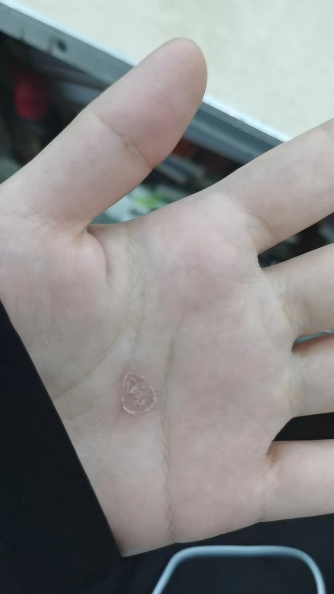 烟烫变迁史，就随便烫一下就这么大一个泡。#刑奴 #女m #女奴 #sm #刑主 #烟烫