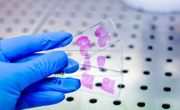 The burden of cancer care and diagnosis requires a scale-up of our diagnostic stewardship. We recommend that cancer screening and Histo-pathological slide reading be routinely done by Medical Laboratory Scientists at primary, secondary and even tertiary level.