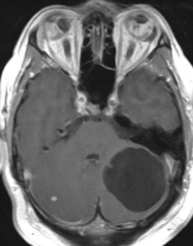 Can you get the diagnosis just from this image? 
25 y/o female 🧠