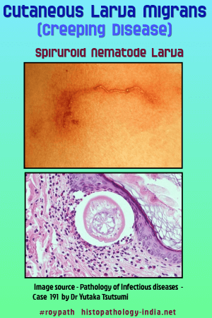 schowardjd's tweet photo. @Sthanu5 Dx: cutaneous larva migrans w/ bullous lesions

(image credit: @DrSampyRoy, #RoyPath, https://t.co/YrbL18qe3O) https://t.co/oWcvLmSKBt
