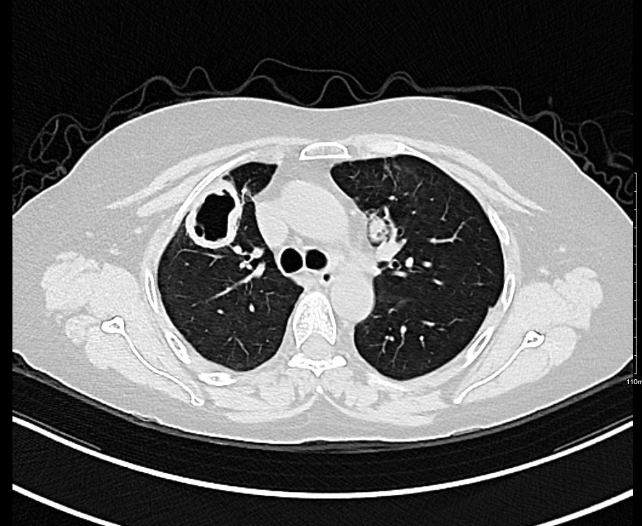 IhabFathiSulima's tweet photo. 50 years old lady with #hemoptysis and impaired #Kidney function.
#Inflammatory markers are raised.
#C_ANAC and #P_ antibodies ANCA are positive
What is the most likely diagnosis or differential diagnosis ? https://t.co/eShYzLFMAs