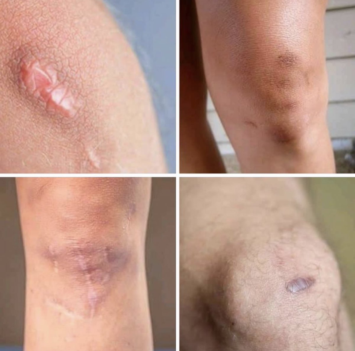 si no tienes uno de estos en tus piernas tu infancia fue aburrida