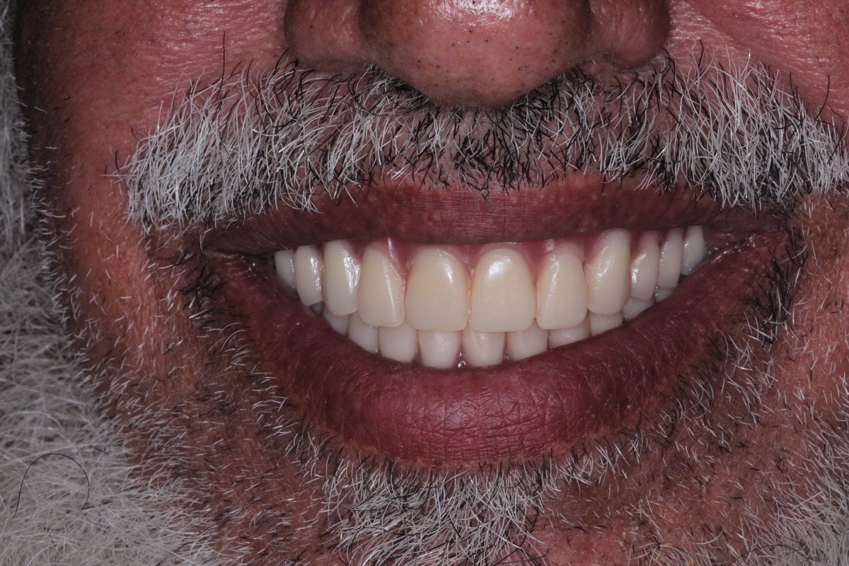 vBvndvr's tweet photo. My First Complete Denture with my colleague @sas_i7   👌🏻 https://t.co/iUTMg737ah