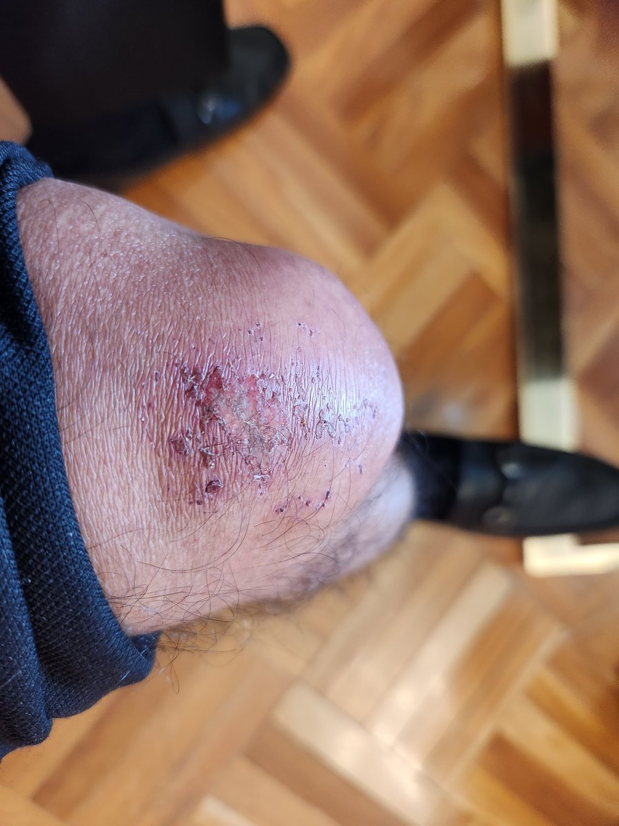 #DeRodillasAntePetro
Termina una de las semanas más dolorosas para el presidente Petro en el sentido literal de la expresión: la selfi de su rodilla, subida en su cuenta de Twitter, con que excusó su ausencia de cinco días, dio la vuelta al mundo e impresionó a media humanidad.