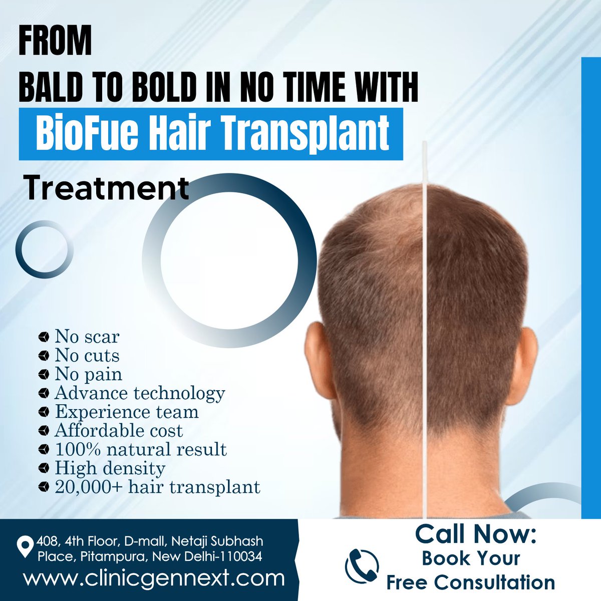 clinicgennext's tweet image. From Bald To Bold in No Time With
Bio Fue Hair Transplant Treatment

Get Your Younger Look Back With
Hair Transplantation Treatment At ClinicGen.Next

-
-
-
-
#clinicgennext #gennextpharma #drkunalsingh #drmeghasingh
#hairtransplantcost #hairtransplantcostindia