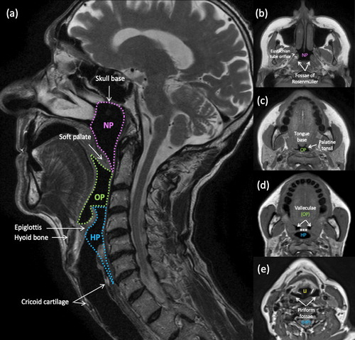 HeadNeckRads's tweet photo. Imaging of pharyngeal pathology

Open access pictorial review @RaviLingam28 in @BJR_Radiology https://t.co/llvJGnRaZY
