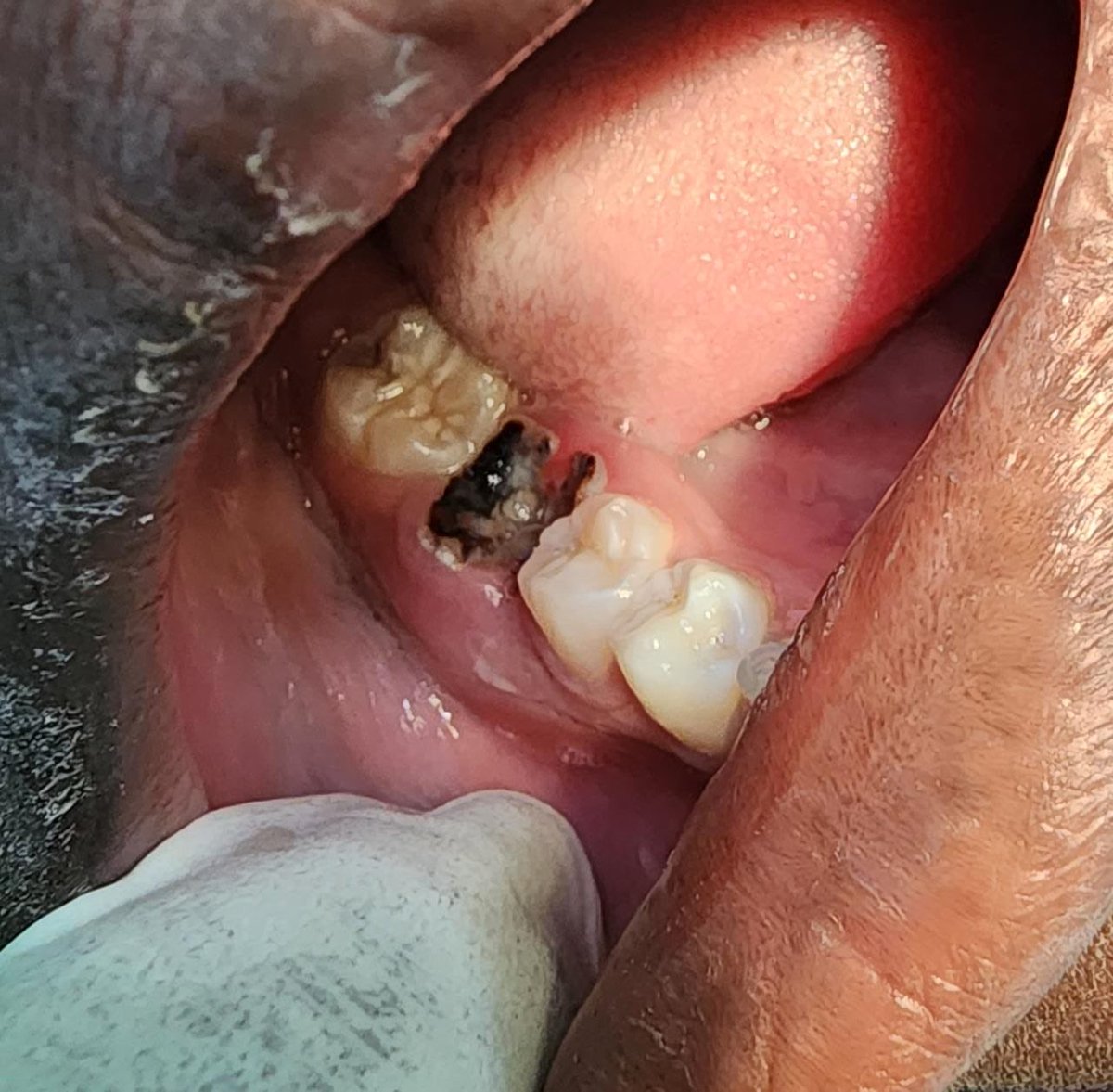 Do you know that dental Carie’s is not only destroying the tooth?  Dental Caries is arguably the most prevalent chronic disease affecting humanity.   It causes significant pain, bad breath, lung and brain abscesses and it can destroy your relationships.