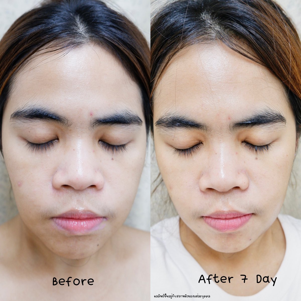 JA_quip's tweet photo. สรุปชอบตัวนี้สุด ˚ ༘♡ ขวดที่สองแล้ว Effaclar Serum 🔖 ตอบโจทย์ปัญหาสิวอุดตัน+ขึ้นซ้ำซากมากในช่วงที่เป็นปจด. เจอตัวนี้สิวขึ้นซ้ำลดลง พอเริ่มเจ็บ ๆ ก็หยิบมาใช้เลย ตัวนี้ช่วยเรื่องรอยจากสิวด้วยใช้เร็วรอยจางเร็ว เนื้อเซรั่มซึมไว ไม่เหนอะผิวอันนี้ชอบเป็นพิเศษ https://t.co/16jELMDLy8
