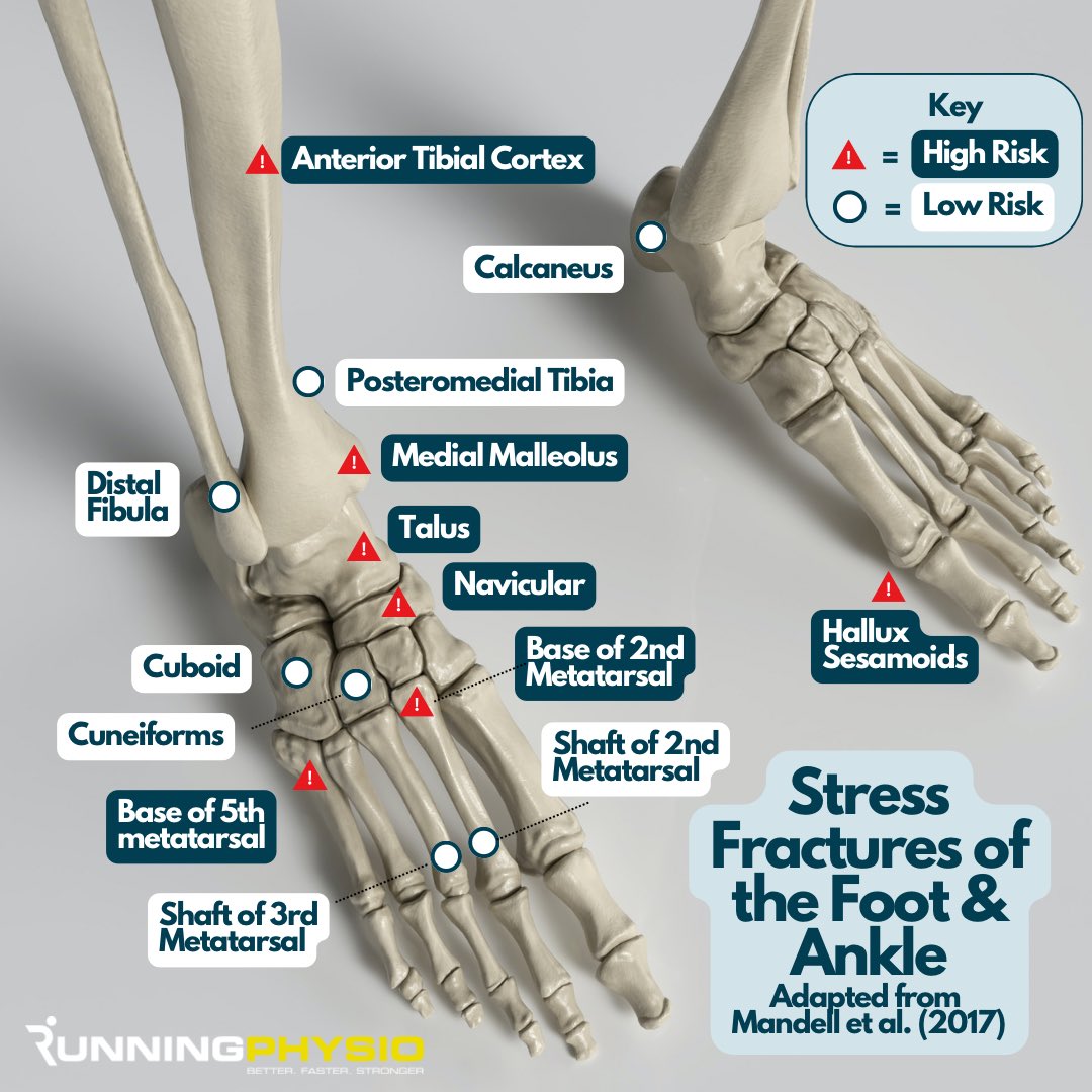 tomgoom's tweet image. ❗️Stress fractures of the foot and ankle 

Note the ‘High Risk’ sites - these require rapid investigation and careful management.

The most common stress fractures of the foot and ankle are low risk - posteromedial tibia, 2nd/ 3rd metatarsal and calcaneus.

Please like and share…