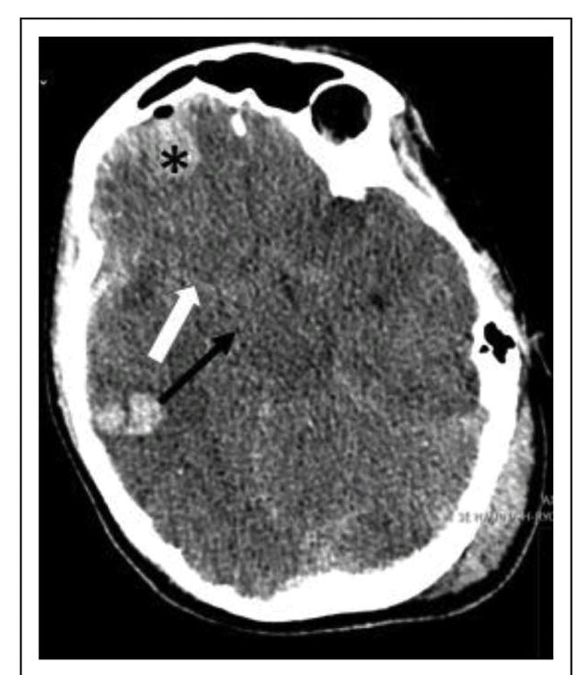 LeslieMegom's tweet photo. 🧠🩸Tratamiento de la lesión cerebral traumática grave💥🩸 en las primeras horas🕔 posteriores a la lesión.
⏬️🧠Terapias para reducir la presión intracraneal.
⏩️🧠MONITOREO  CUIDADOS NEURCRÍTICOS.
▪️PIC < 20-22 mmHg
▪️PPC ≥ 60 mmHg
▪️BT sistólica >100 mmHg
▪️pO2 >10kPa
🧵👇 https://t.co/uNlcVeyi5q