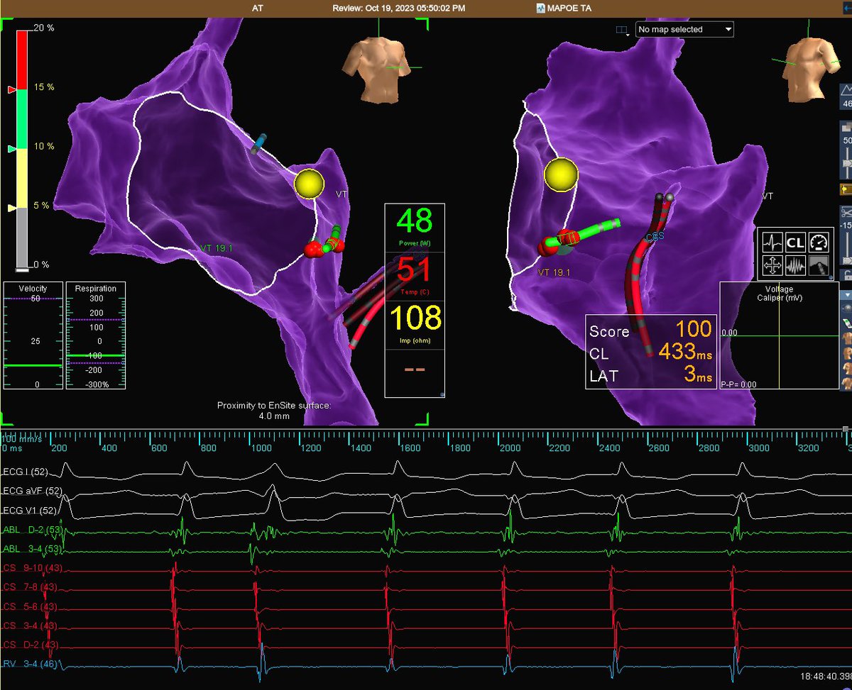 Paciente con atde de dextrocardia y TPS . 

Imagen izquierda: OD 15grados (  compatible con OI) 

Imágen derecha : OI 40 grados( compatible con proyeccion lateral) 

Lateral derecha 115 grados ( verdadera OD) 

SITUS AMBIGUO!!!!! 

#SVT #ep #fellowfirst #abbott  #ablation