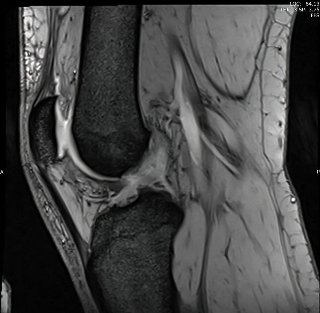 aossmjournals's tweet image. Hot off the press! #ACLrepair with #InternalBrace augmentation has favorable clinical and functional outcomes comparable to #ACLreconstruction as well as a significantly reduced surgery time. #OpenAccess
ow.ly/gXNi50PXQ0e