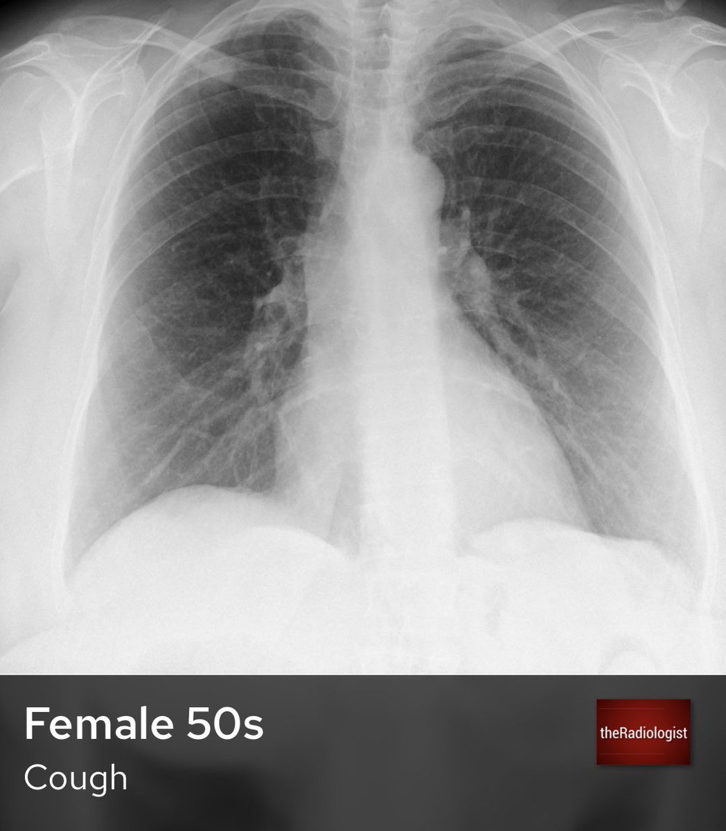 Female in her 50s presents with a cough. Can you see an abnormality?
