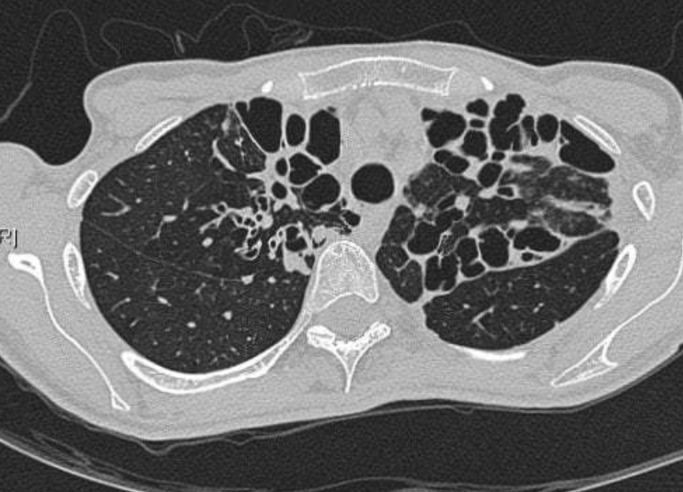IhabFathiSulima's tweet photo. 65 male with Long history of chest infections.
Diagnosis ? https://t.co/nvLkt9s627