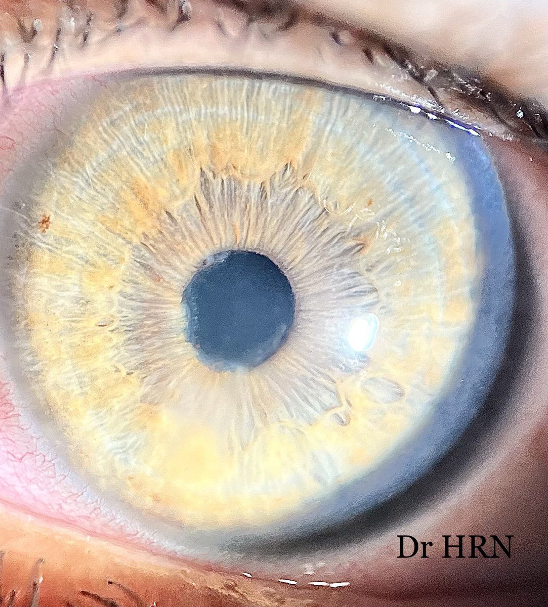 What would be your diagnosis here #OphthoTwitter ?? 

#OphthoX #MedTwitter #Ophthalmology