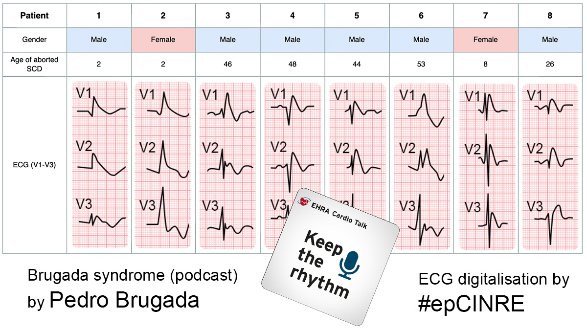 #EPeeps One of the most cited publication (4576x) in cardiology ❤️. 
Brugada brothers (in 1992) described 📜 8 patients with 'RBBB'. 
ECG digitalisation 💻 by #epCINRE. 
#BrugadaSyndrome (podcast) by Pedro Brugada on (#EHRA Cardio Talk).
epcinre.sk/en/brugada-syn…