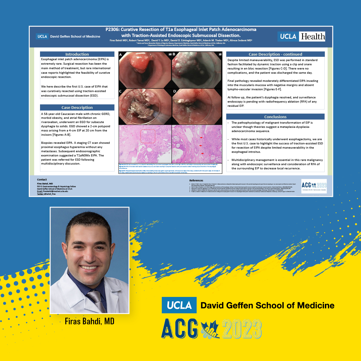 UCLA Gastroenterology and Hepatology (@uclagihep) on Twitter photo #ACG2023 Poster - Curative Resection of T1a Esophageal Inlet Patch Adenocarcinoma with Traction-Assisted Endoscopic Submucosal Dissection
👏<a href="/bahdi_firas/">Firas Bahdi</a>
👥<a href="/RobertTamai/">Robert Tamai</a> David Y. Lu Daniel Eshtiaghpour <a href="/AdarshThakerMD/">Adarsh M. Thaker, MD</a> <a href="/ASedarat/">Ali Sedarat, MD</a>
👉Monday, October 23
👉10:30 am – 4:15 pm #ACG2023 Poster - Curative Resection of T1a Esophageal Inlet Patch Adenocarcinoma with Traction-Assisted Endoscopic Submucosal Dissection
👏<a href="/bahdi_firas/">Firas Bahdi</a>
👥<a href="/RobertTamai/">Robert Tamai</a> David Y. Lu Daniel Eshtiaghpour <a href="/AdarshThakerMD/">Adarsh M. Thaker, MD</a> <a href="/ASedarat/">Ali Sedarat, MD</a>
👉Monday, October 23
👉10:30 am – 4:15 pm