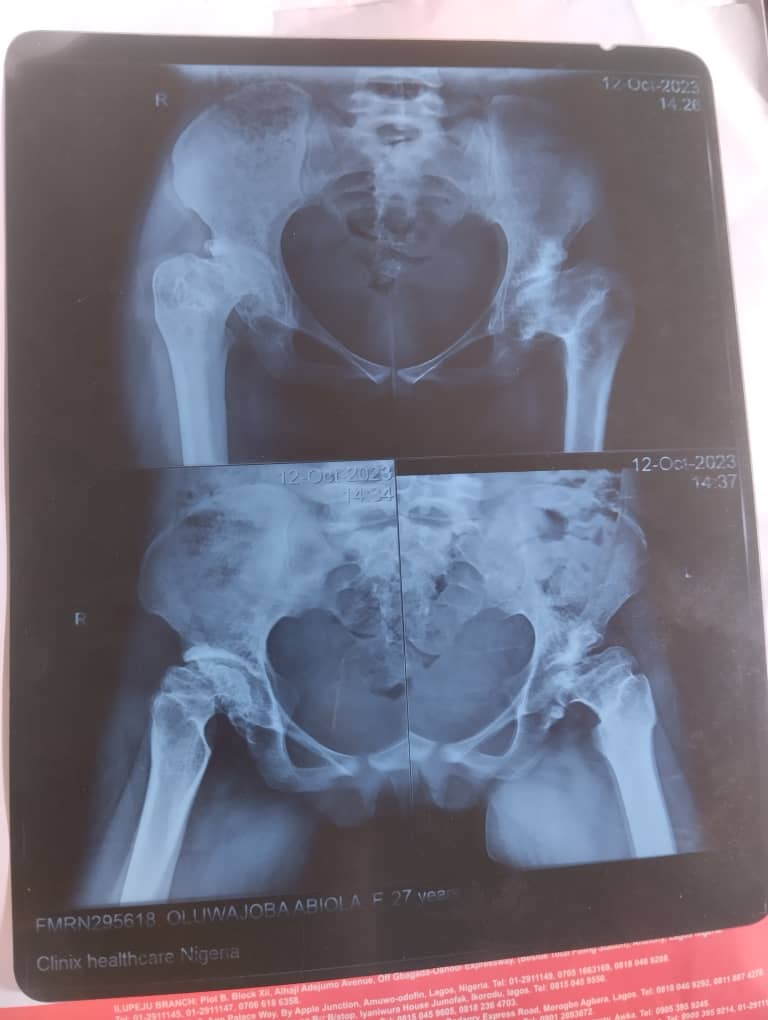 OsunTwitta's tweet image. One of us @oluwajobabiola needs our help.

Abiola Deborah, OLUWAJOBA who is suffering from  bilateral avascular necrosis, complication of sickle cell anaemia is hoping to raise a sum of #8m for a total bilateral hip replacement at Summit Orthopedic Hospital, Lagos.