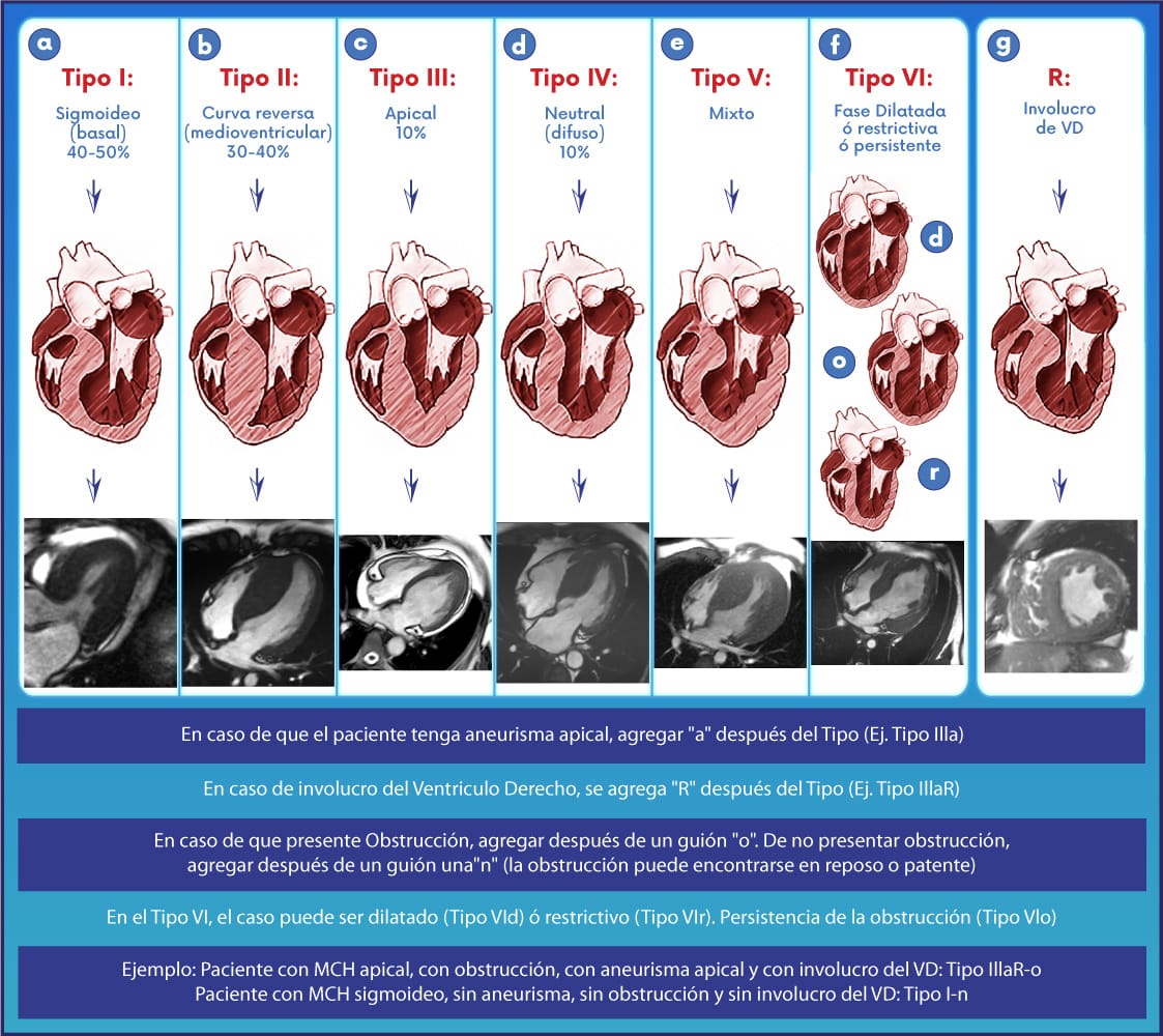 javier20ch's tweet photo. ✨️Nueva "clasificación de Llamas" para Miocardiopatía Hipertrófica.
⚠️Recientemente propuesta por mi maestro @galle_llamas en el #ESCCongress2023 🫀🔥💯👌
✅️Una forma más completa y pragmática de clasificar el amplio espectro de la MCH. Gran aporte de la Cardiología🇲🇽!
✍️🧐⤵️ https://t.co/jRzyHDlUos