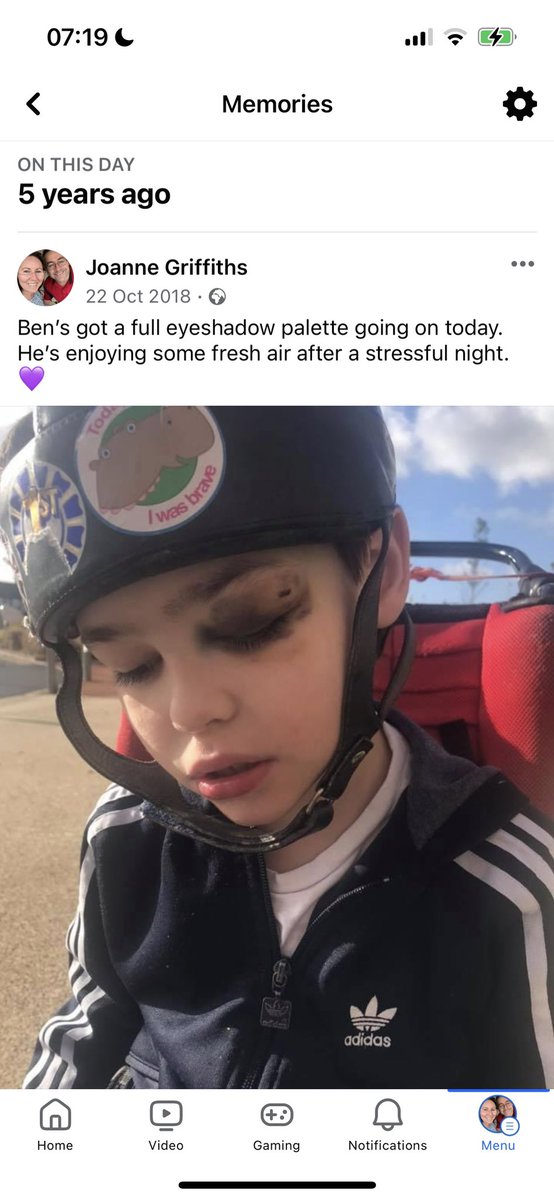 🚨 Urgent! Our son Ben suffered a severe eye injury due to hundreds of seizures caused by running out of his full extract cannabis. Lack of reliable access to medication is a national scandal. Let's raise awareness and demand change! 💔💪 #AccessToMedication #HealthcareRights
