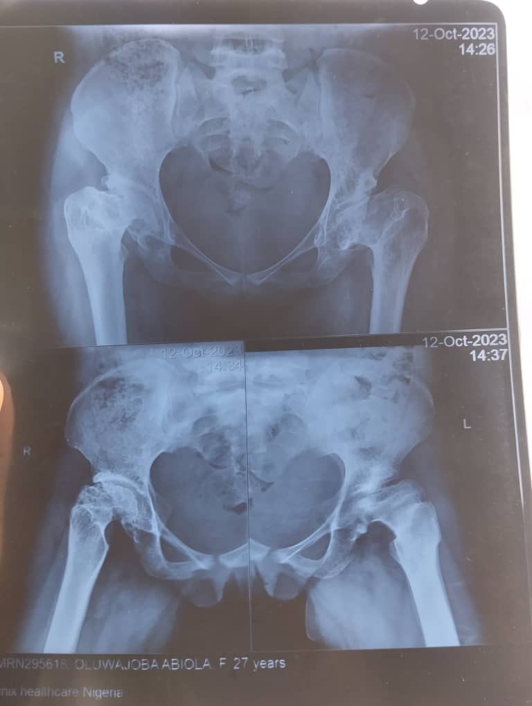 My friend <a href="/oluwajobabiola/">Abiola Onílèkè 😉</a>  needs our help.

I want us to help her walk again and walk fine, I have known her for a long time, she's a jovial, friendly and loving person.

We need #8m to get the surgery and post surgery treatment sorted.

Kindly help us 🙏🙏🙏

Your RT will go a