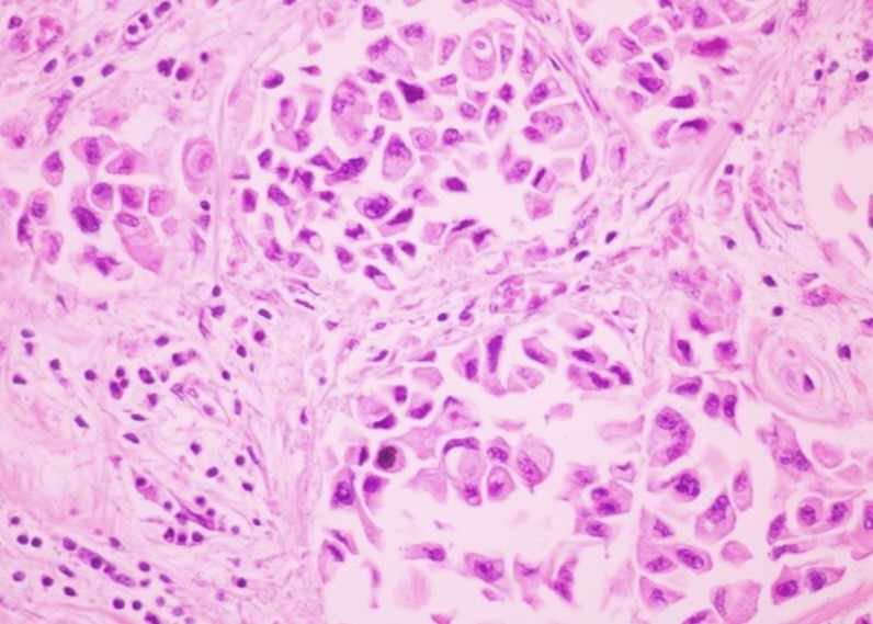 How #cancer hijacks healthy breast tissue for cancer growth remains a longstanding mystery.

But new research, led by <a href="/mjgmilevskiy/">Michael Milevskiy</a> and <a href="/HDCoughlan/">Hannah Coughlan</a>, could help solve this after shedding new insight into how breast cells regulate #GeneExpression.

🧵1/2

sciencedirect.com/science/articl…