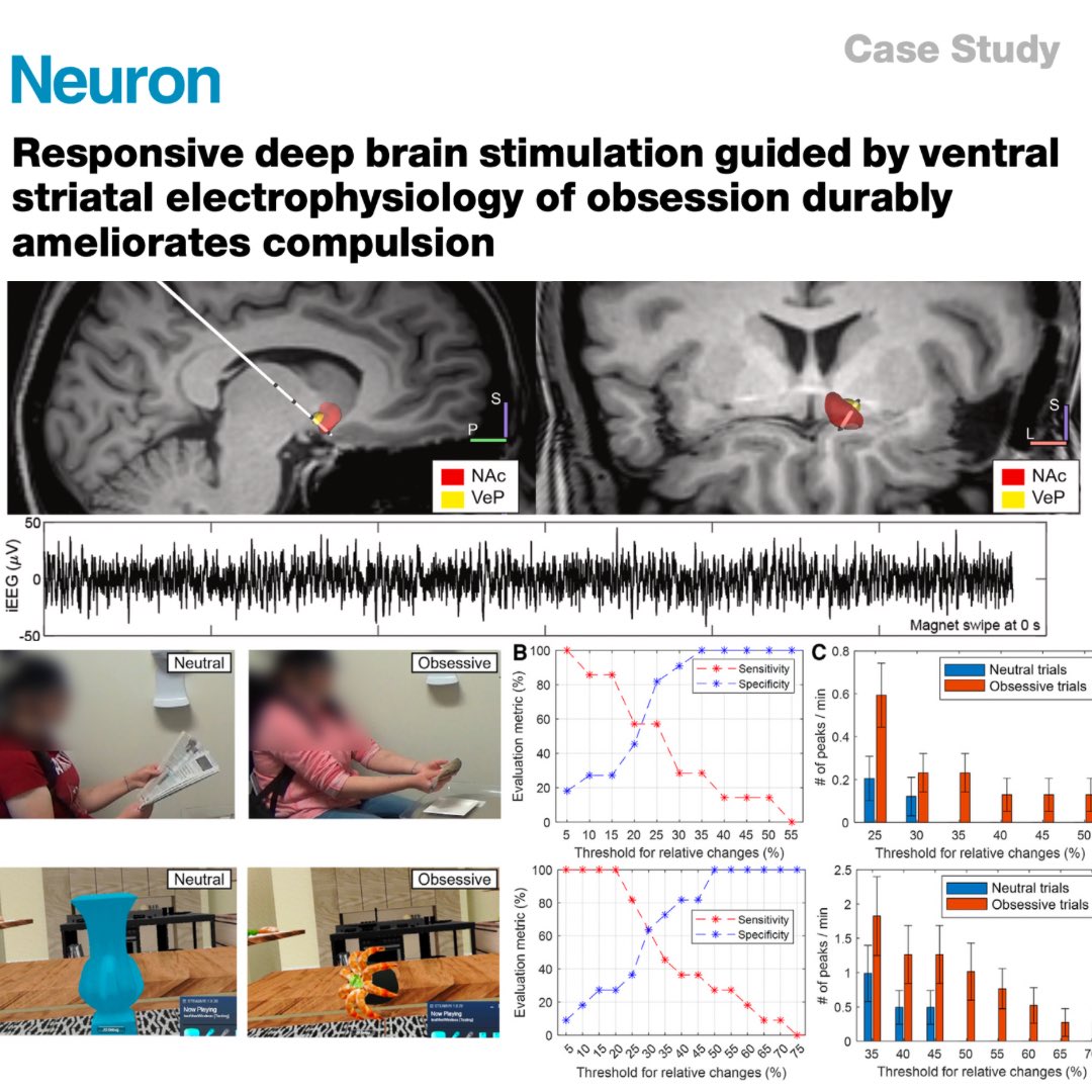 Our latest publication in @NeuroCellPress describes the first-in-human application of responsive deep brain stimulation to treat obsessive symptoms in OCD. This paper embodies our lab’s mission to explore novel and effective applications for DBS. @PennNSG @PennMedicine