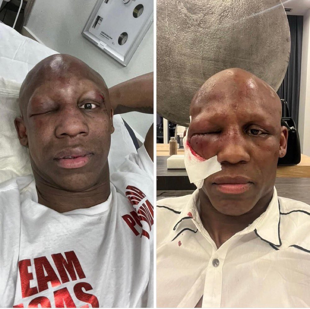 TRUEBLACK_Media's tweet image. "Concerned for Yordenis Ugas' eye health. It might be time to consider transitioning to a new chapter – perhaps as a trainer or starting a podcast. 🥊🎤 Passing the torch is a part of the game. #BoxingLegacy #RetirementThoughts" @YordenisUgas