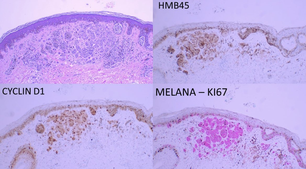 👩🏽‍🦰 thigh lesion Atypical sptizoid tumor ROS, ALK, NTRK negative PRAME focally positive. Ki-67 positive in the deeper cells. I called it #melanoma. Any thoughts? #path #pathology #dermatology #dermatopathology #oncology