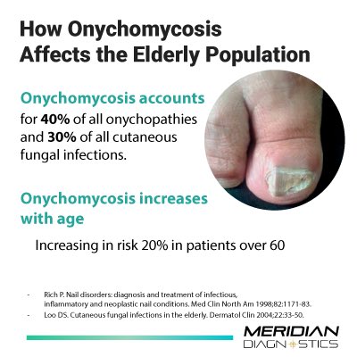 MeridianDiagLab's tweet photo. The most obvious symptom of nail fungus is a thickened, yellow toe or fingernail. The nail may also have white spots or streaks and separate from the nail bed. 

Learn more about the common causes of #nailfungus in the link below:

https://t.co/uRGMxSIZHi

#meridiandiagnostics https://t.co/aTAvpIsCRj