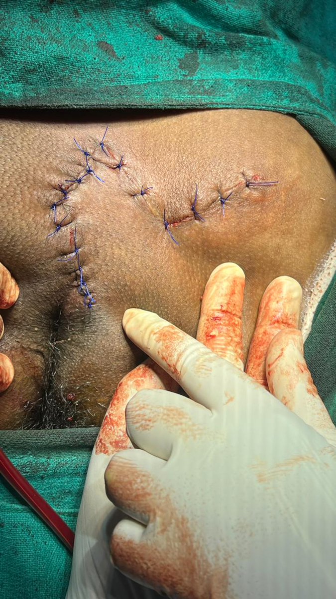 Pilonidal sinus weekend
#SoMe4Surgery #ruralsurgery