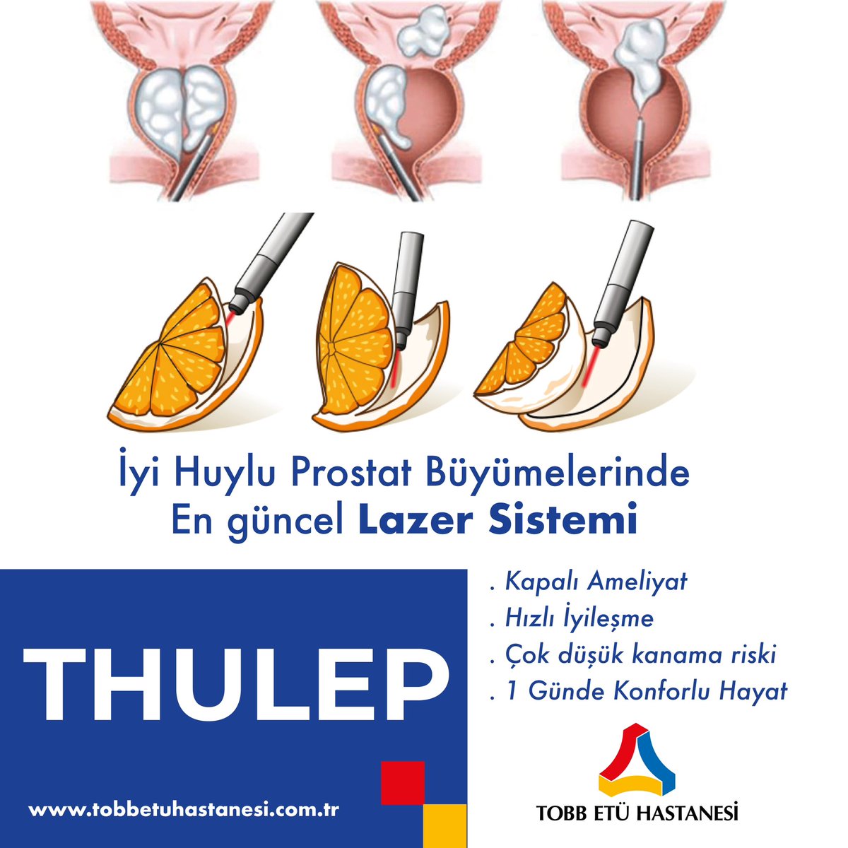 tobbetuhastane's tweet photo. İyi Huylu Prostat Büyümelerinde En güncel LAZER SİSTEMİ
🔹 THULEP🔹
✔️Kapalı Ameliyat
✔️Hızlı İyileşme
✔️Çok düşük kanama riski
✔️1 günde konforlu hayat #üroloji #ankara #thulep #prostat #prostattedavisi #lazer #urology #doctor #urologia #medicine #surgery #urologist #health https://t.co/wHJdMvhG1L