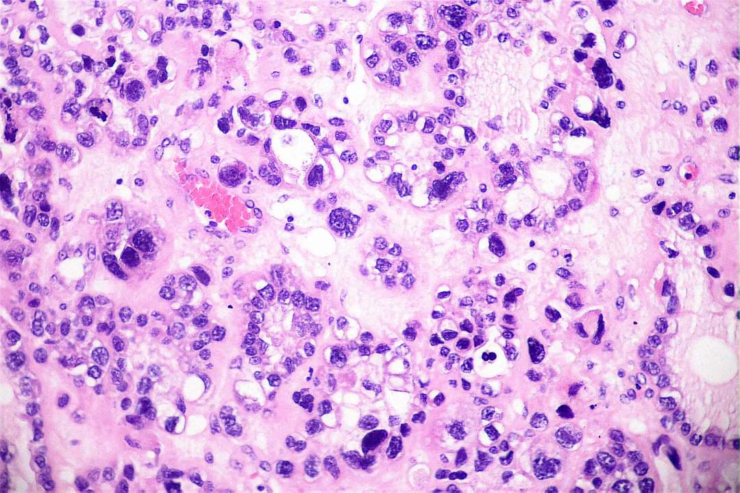 GeronimoJrLapac's tweet image. 🔬Ovary: Clear cell carcinoma 
👉Architectural pattern: tubulo-cystic, papillary and solid.
👉Cells with clear and eosinophilic cytoplasm.
👉Do not grade these Ca - All are high grade.
👉Nuclear pleomorphism may be present focally and mitotic activity is generally low.
#gynpath